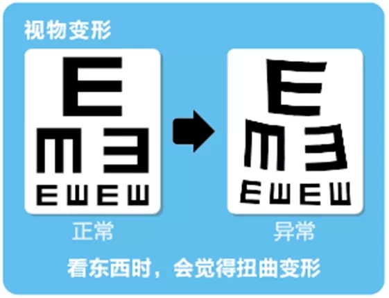 視網(wǎng)膜脫離啥癥狀？這張圖告訴你！