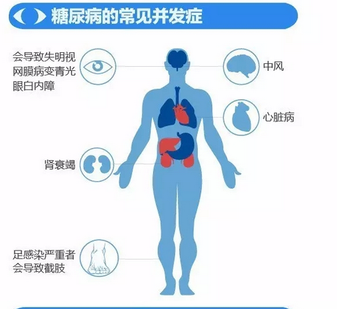 你造嗎？糖尿病晚期眼睛會致盲！