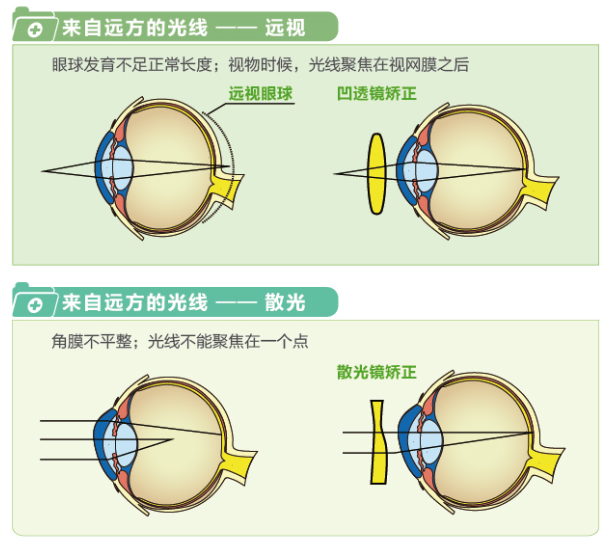 【看圖解】一張圖教你看懂近視、遠(yuǎn)視和散光