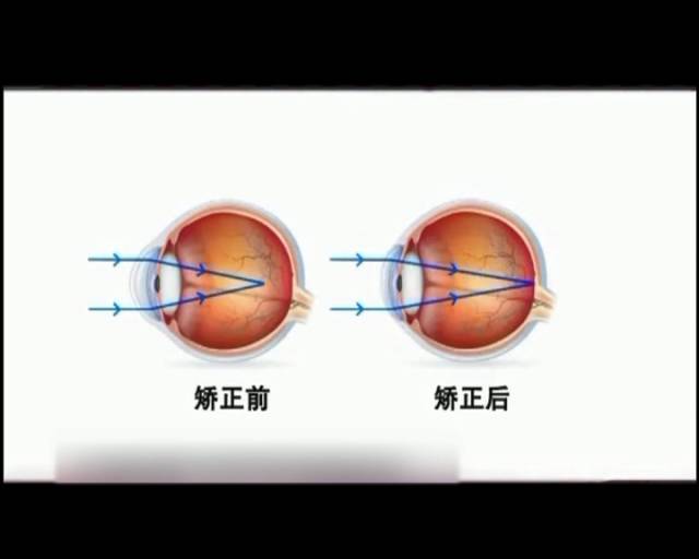 一夜之間真的能改變視力嗎？