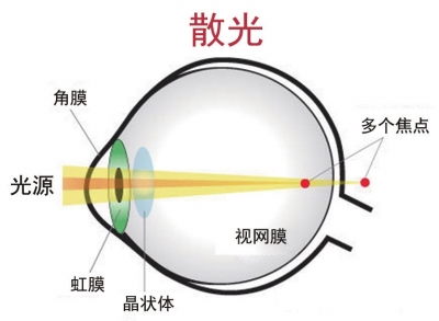 關于散光配鏡的兩大誤區(qū)