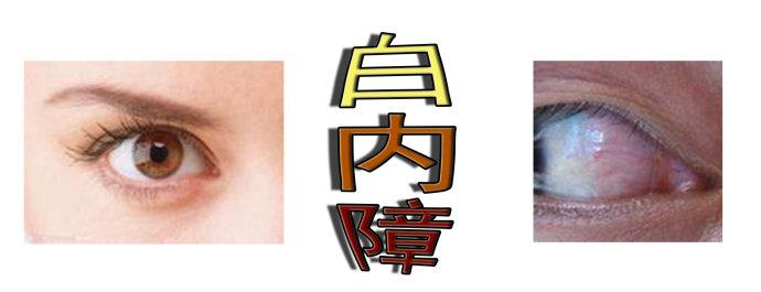 白內(nèi)障手術(shù)會反復(fù)嗎？