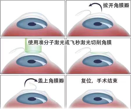 如果眼睛近視了該怎么？