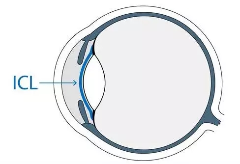 想做ICL晶體植入術(shù)，你需要了解的全在這里!